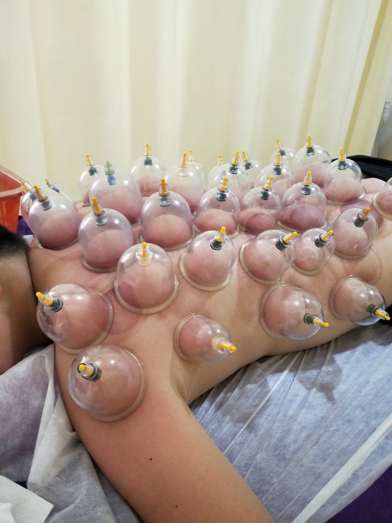 拔罐刮痧
